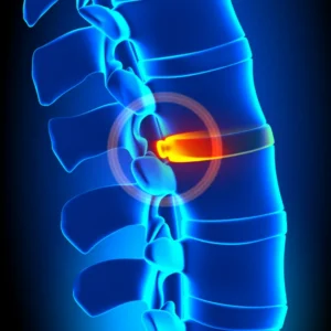 bulging or protruding disc