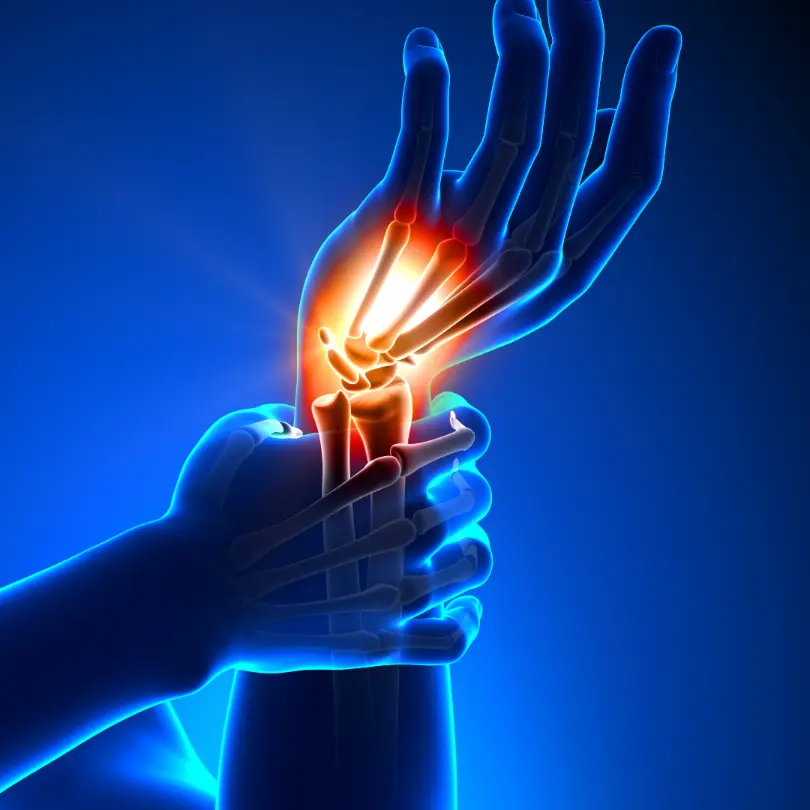 carpal tunnel syndrome