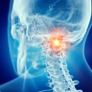 Cervical radiculopathy
