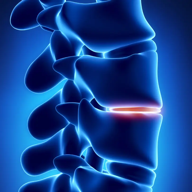 Degenerative disc disorder