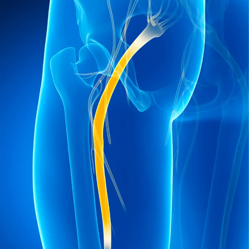 Sciatica